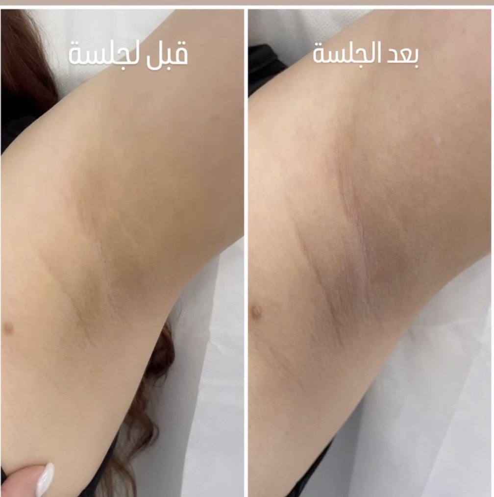 إزالة شعر بالليزر